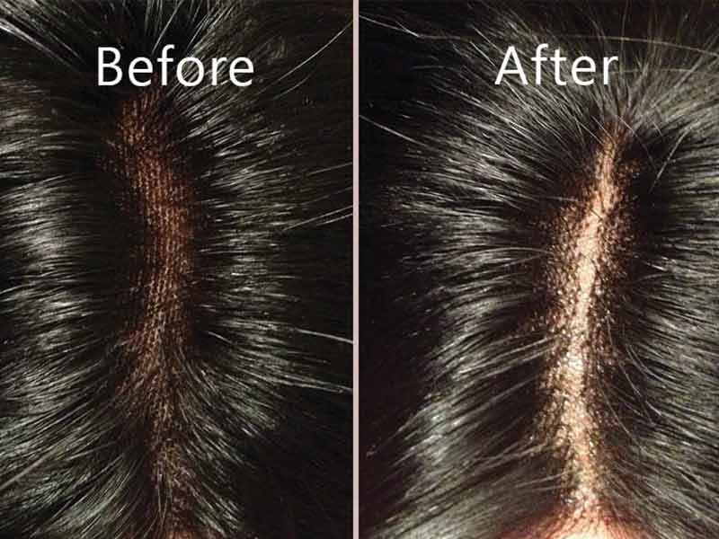 Lace Closure 101: What Is It And How Does It Work?