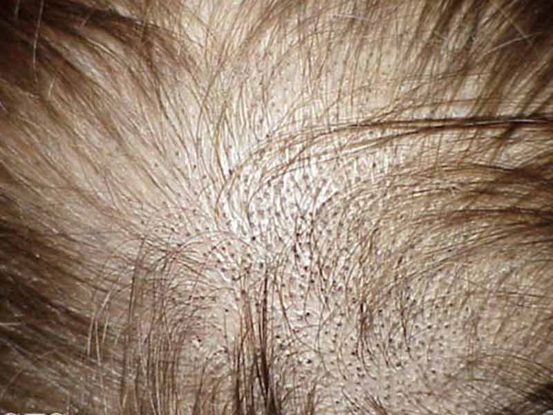 What Are The Signs Of New Hair Growth?