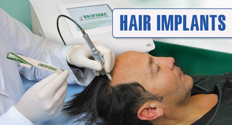 Are Hair Implants Really Worth Taking? | Implant Vs. Transplant