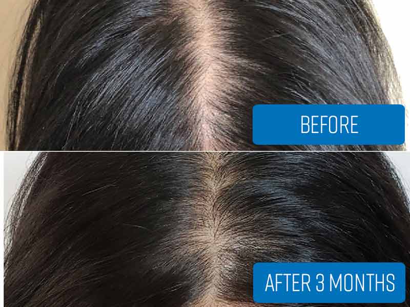 A Closer Look At Biotin For Hair Growth Results Lewigs