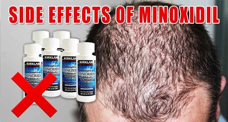 The Good, The Bad, And The Side Effects Of Minoxidil