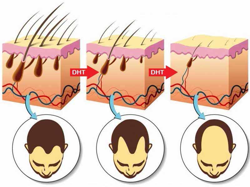 Does Smoking Cause Hair Loss? Myth Debunked!