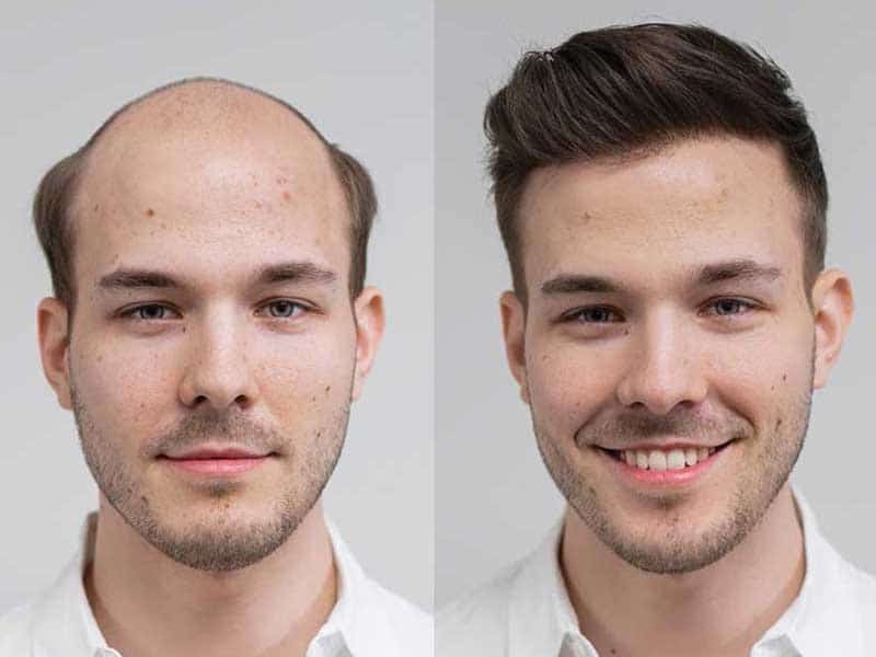 Men women on bald