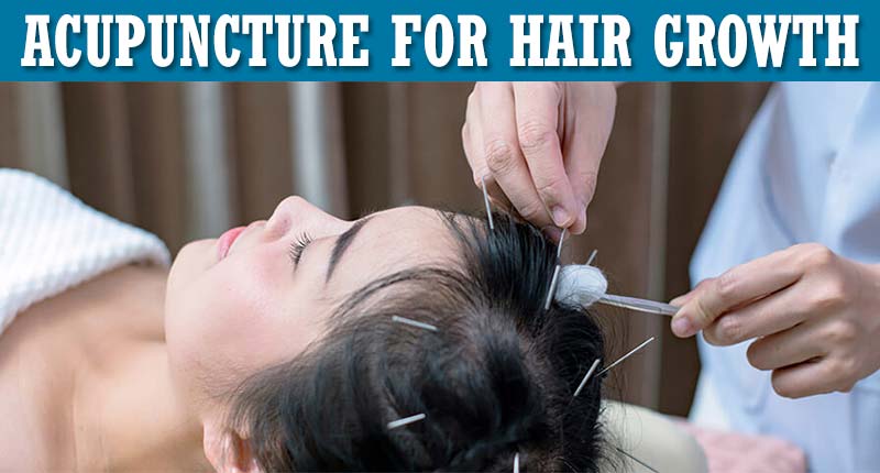 Acupuncture For Hair Growth - Is It A Viable Option?