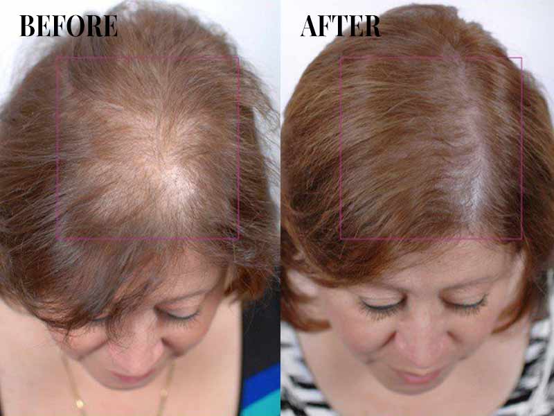 Acupuncture For Hair Growth - Is It A Viable Option?