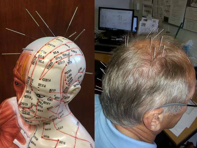 Acupuncture For Hair Growth - Is It A Viable Option?