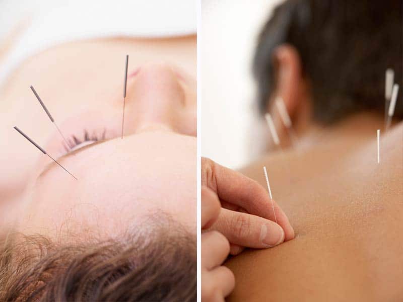 Acupuncture For Hair Growth - Is It A Viable Option?