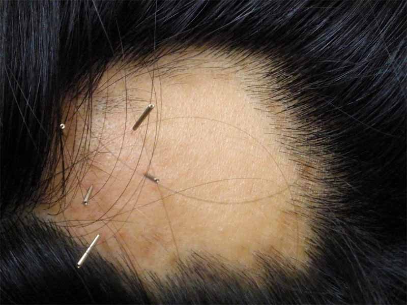 Acupuncture For Hair Growth Is It A Viable Option? Lewigs