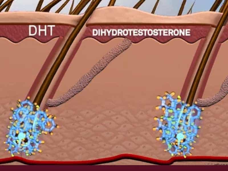 Does High Testosterone Cause Hair Loss? It Really Does!