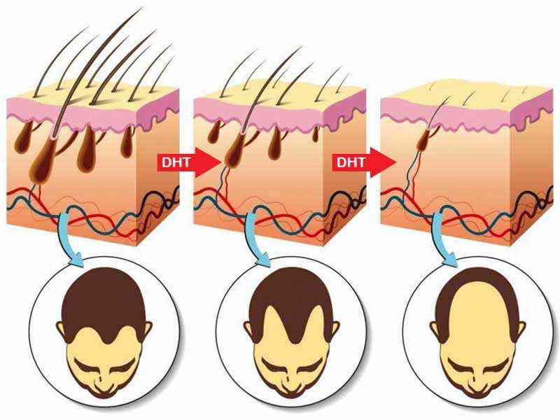 Does High Testosterone Cause Hair Loss? It Really Does!