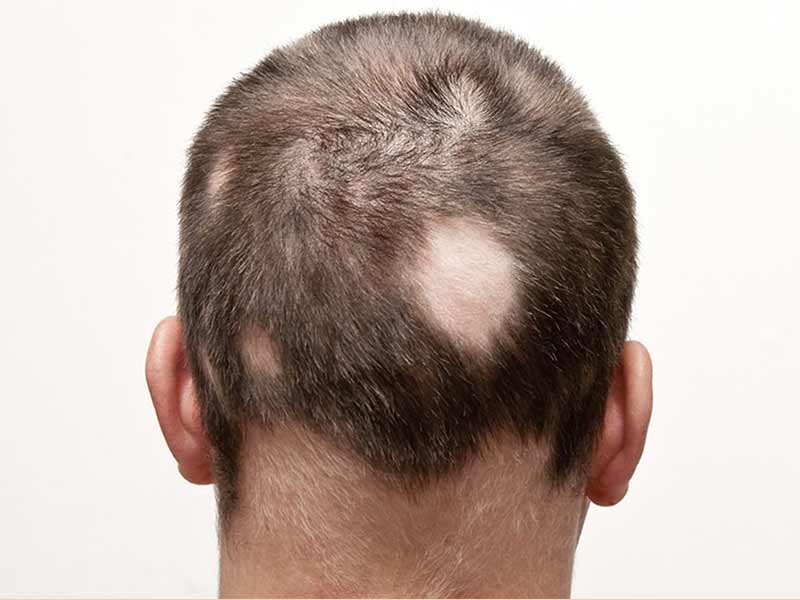 Alopecia Areata