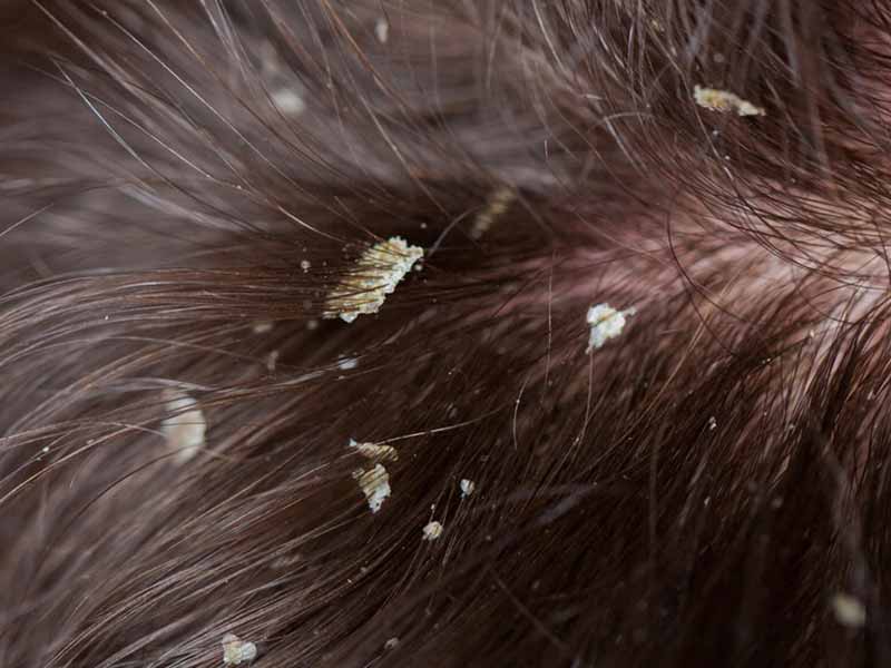 Scalp Build Up: Don’t Mistake It For Dandruff!