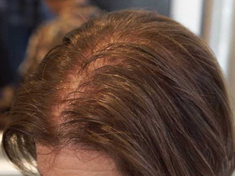 The Brand-New Idea On How To Hide Scalp With Thin Hair