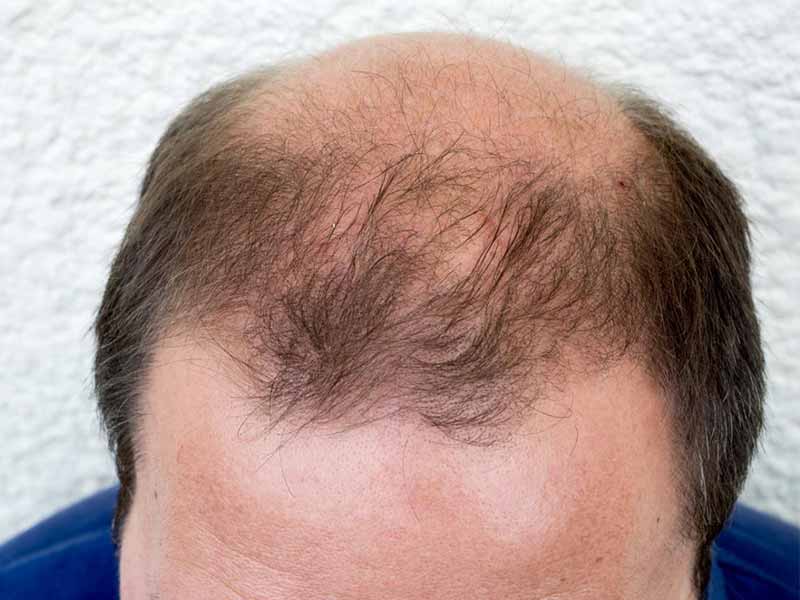 Why Do Men Go Bald And Women Don't? Here's The Answer!