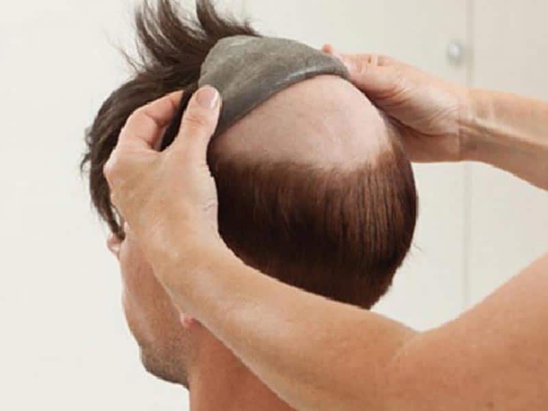 Why Do Men Go Bald And Women Don't? Here's The Answer!