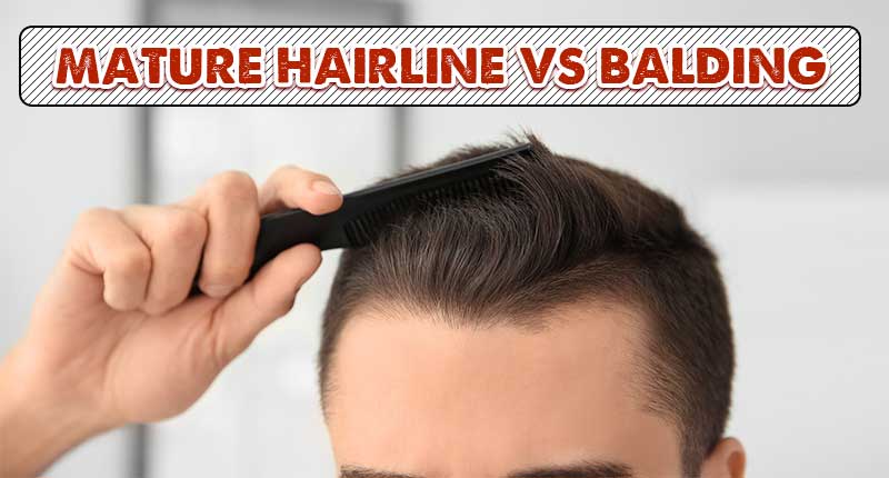 Mature Hairline Vs Balding: Are These Two The Same?