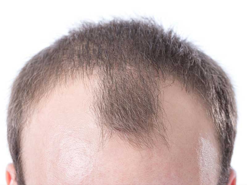 Mature Hairline Vs Balding: Are These Two The Same?