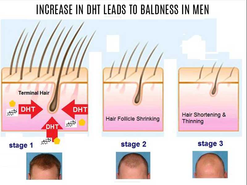 Mature Hairline Vs Balding: Are These Two The Same?