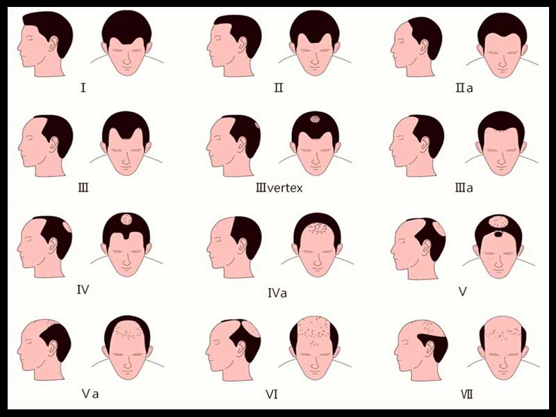 Mature Hairline Vs Balding: Are These Two The Same?