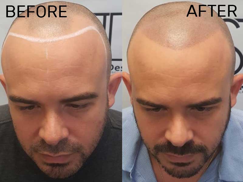 Hairline Tattoo - Is It A Viable Option For Thinning Hair Men?