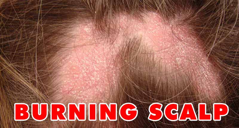 Itchy Burning Scalp Hair Loss : How Is A Burning Scalp Related To Hair