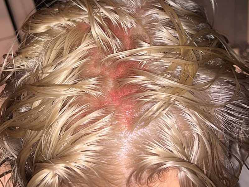 what-are-common-causes-of-a-sore-scalp-vrogue-co