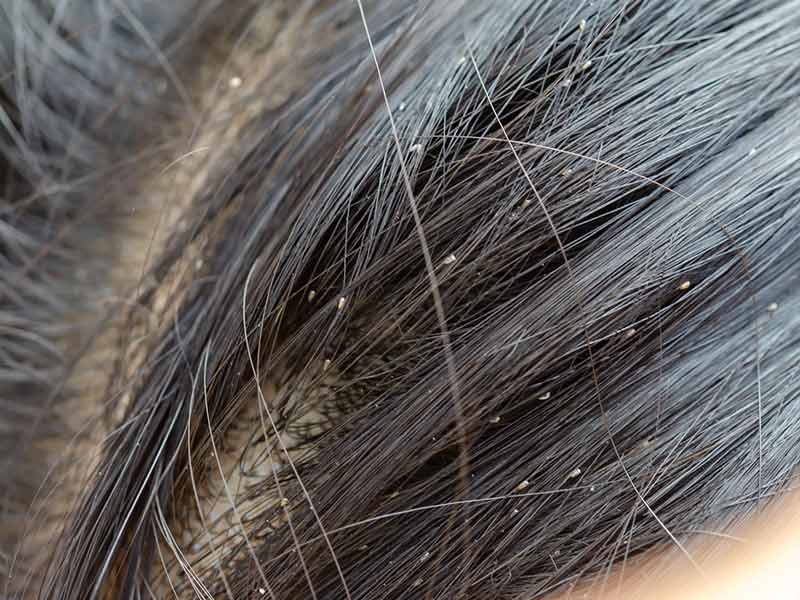 Irritated With Your Burning Scalp? Here's How To Deal With It