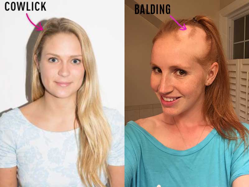 Cowlick Vs Balding - How To Differentiate These Two?