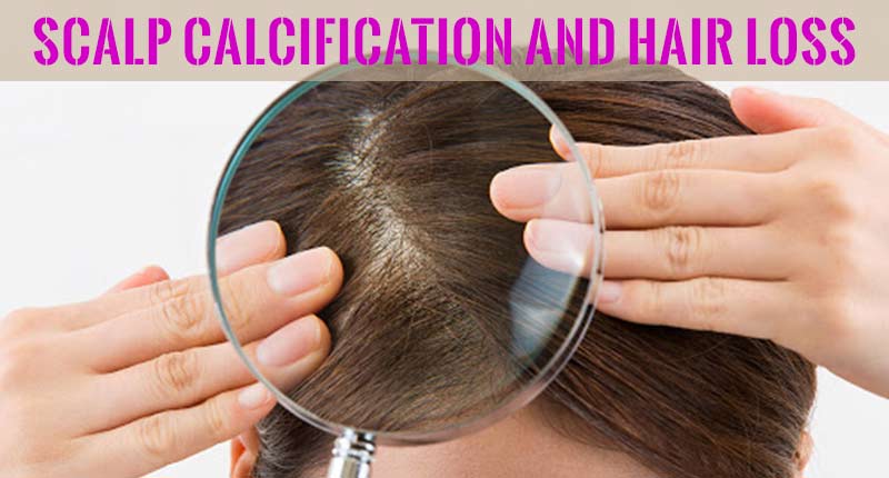 Crack The Relation Between Scalp Calcification And Hair Loss