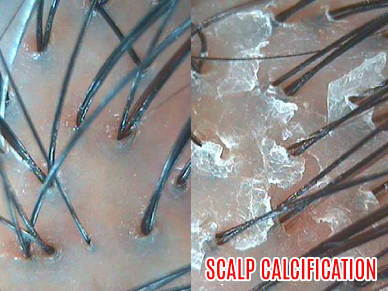 Scalp calcification massage