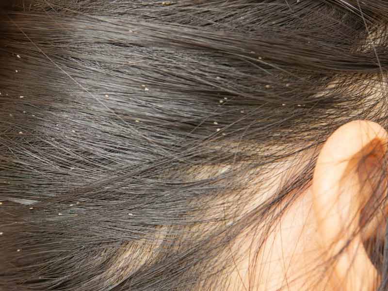 Can Hair Dye Kill Lice? A Controversial Issue People Are Arguing