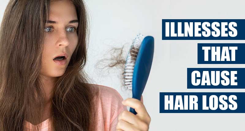 5 Illnesses That Cause Hair Loss People Are Rarely Aware Of